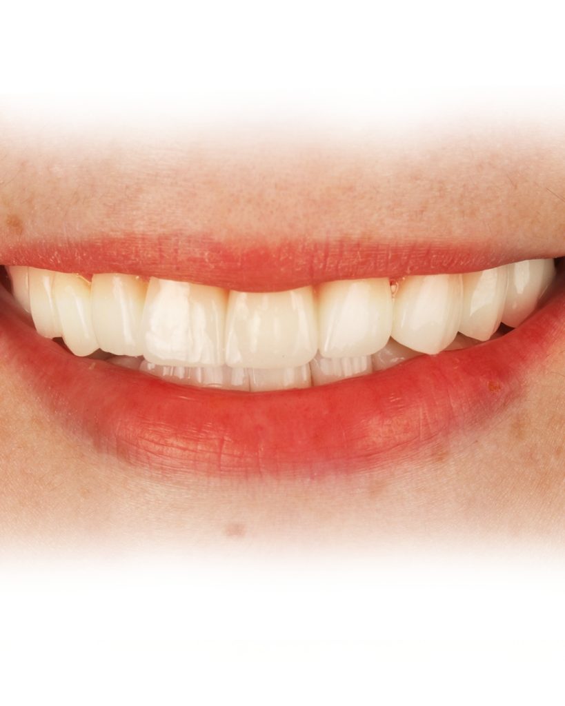 Doğal görünen üst zirkonyum kaplama ve estetik gülüş tasarımı detayları