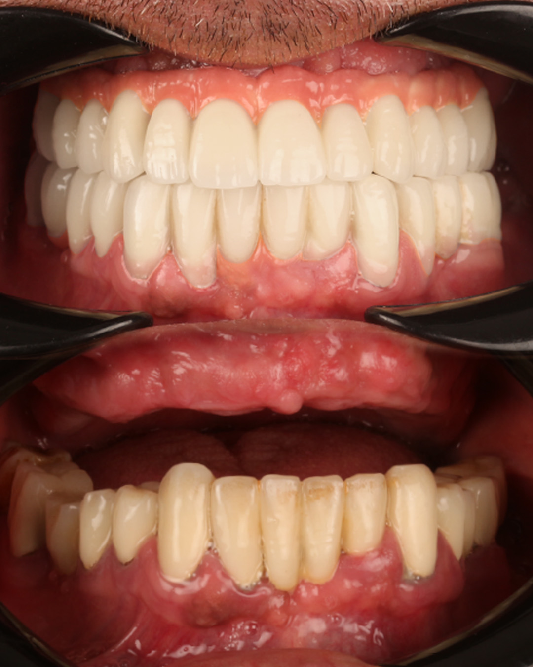 Denizli Diş Hekimi Mustafa Özcan All-on-6 implant tam dişsizlik tedavisi öncesi ve sonrası gerçek hasta sonucu