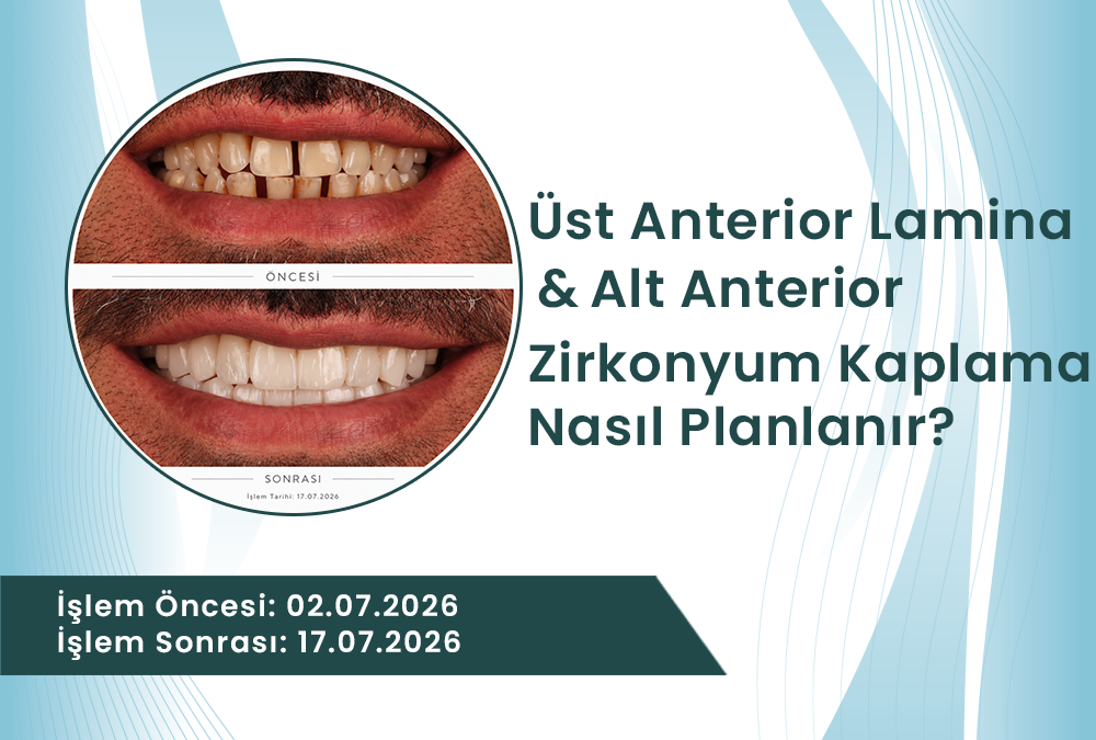 Dt. Mustafa Özcan üst anterior lamina ve alt anterior zirkonyum kaplama uygulaması öncesi ve sonrası