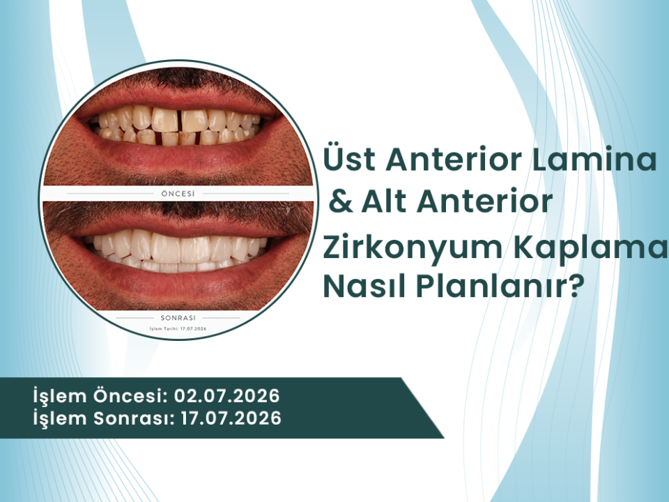Dt. Mustafa Özcan üst anterior lamina ve alt anterior zirkonyum kaplama uygulaması öncesi ve sonrası