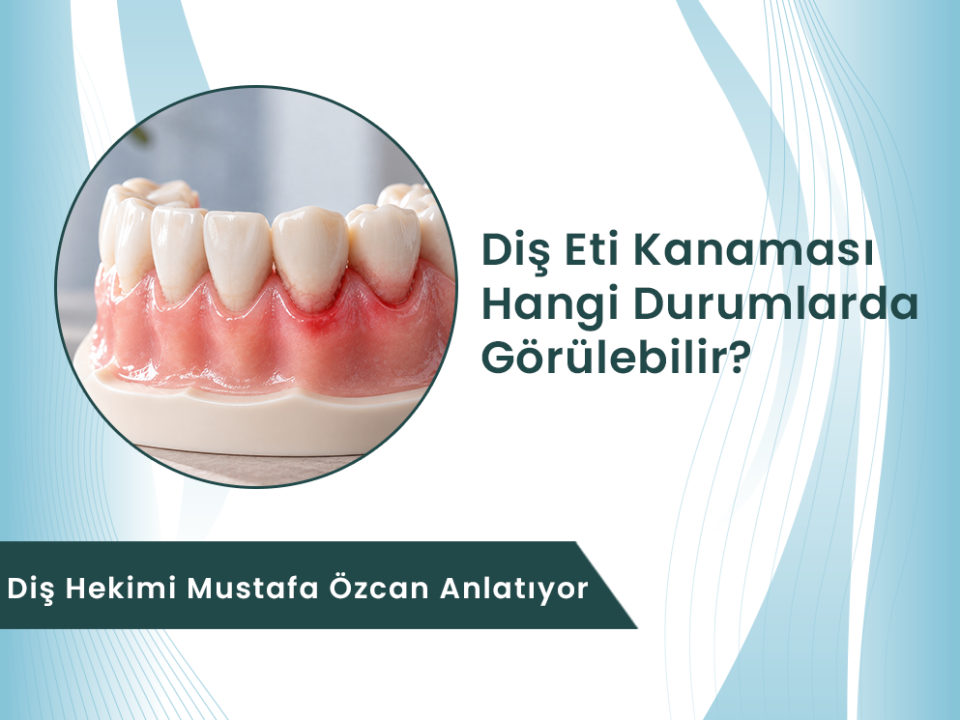 Diş eti kanamasının olası nedenlerini temsil eden diş ve diş eti modeli